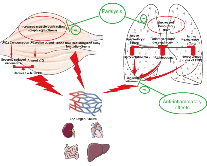 Potential physiopathological effects that explain the benefits of NMBAs in the most severe forms of ARDS. V/Q ventilator/perfusion ratio, FRC functional residual capacity