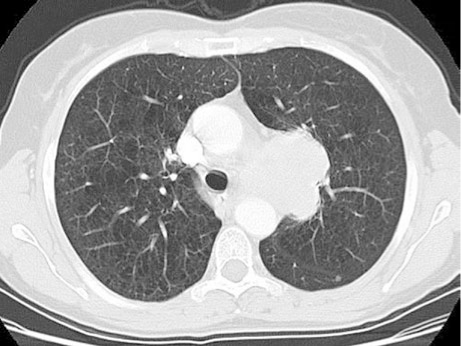 Effects of increase in airway pressure and volume on the heart