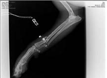Gunshot wound to front of right leg, causing a radial-ulnar fracture and fragmentation of the projectile