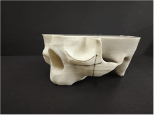 Shows the anatomical landmarks drawn in the model for the future position of zygomatic implants